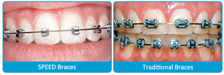 Fast Orthodontic Treatment – How It Differs From Standard Braces